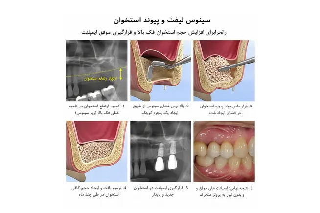 سینوس لیفت و پیوند استخوان برای ایمپلنت فوری دندان جلو