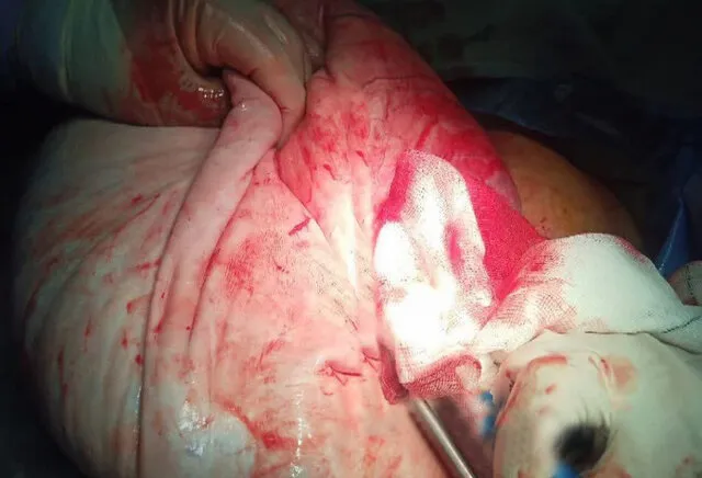 خارج کردن کیست ۱۵ کیلویی از شکم بانوی ۲۲ ساله میبدی