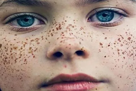 کک و مک و جای جوش صورت چگونه درمان می‌شوند؟