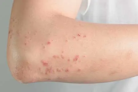 چه کسانی به زونا مبتلا می‌شوند؟