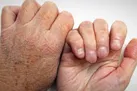 ۹۵ درصد مردم هرگز جذام نمی گیرند/عمده ترین نشانه بیماری