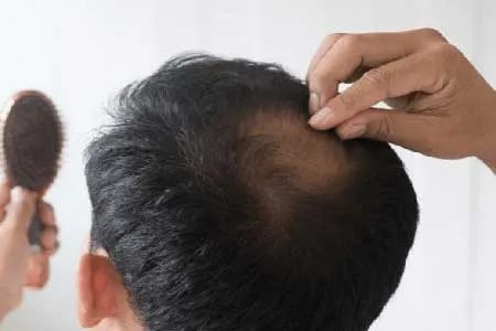 ریزش مو را با طب سنتی متوقف کنید