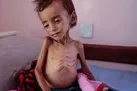 خطر مرگ جمعی در کمین میلیون‌ها کودک یمنی
