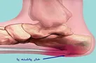 راه‌ های درمان خار پاشنه پا بدون جراحی