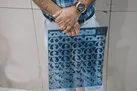 نشانه‌های درگیری ریه در بیماران کرونایی / تزریق واکسن در افراد دارای آلرژی؛ بلامانع