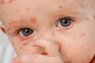 تفاوت سرخک با آبله مرغان چیست؟
