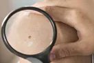 خال هایی که نشانه سرطان دارند