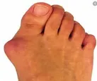انحراف شست پا یا بونیون