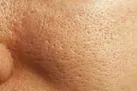 سندرم پوست پرتقال چیست؟
