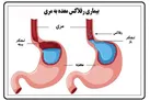 این 2عامل باعث ریفلاکس معده می‌شوند
