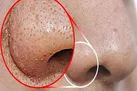 تکنیک های خانگی برای رفع آکنه بینی
