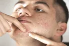 با جای جوش‌ها چه کنیم؟