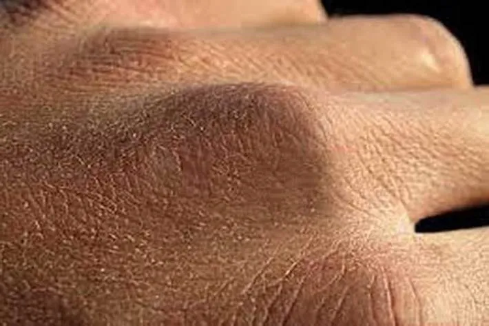 کرونا و خشکی پوست