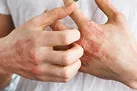 پوست‌هایی که پولکی می‌شوند