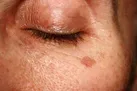 چگونه لکه‌ های کبدی را کم‌رنگ کنیم؟