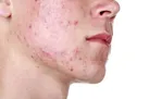 موثرترین روش ها برای جلوگیری از جوش صورت