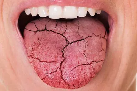 چرا دچار خشکی دهان می‌شویم؟