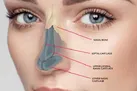 آیا بینى‌ام شکسته است؟