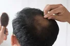 ریزش مو را با طب سنتی متوقف کنید