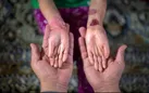 نیمی از بیماران نادر دارو ندارند