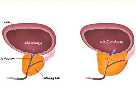 درمان بزرگى پروستات ابتدا با اصلاح سبك زندگى و دارو (فيلم)