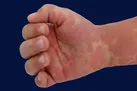 یک عارضه فوق العاده خطرناک دیگر از کرونا