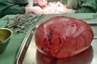 خارج کردن توده ۱۵ کیلویی از بدن یک خانم
