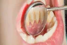 آنچه باید درباره کلسیفیکاسیون دندان بدانیم